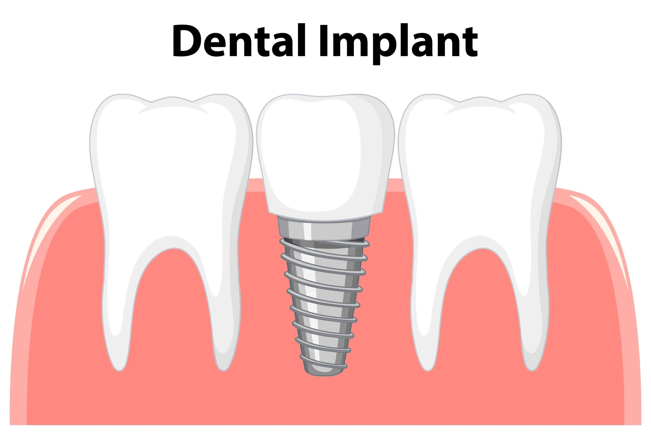 When is the Tooth Attached After the Implant Screw is Placed