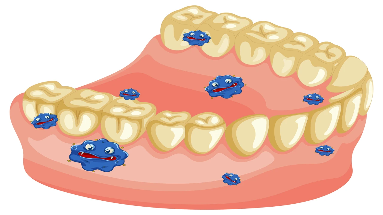 dental plaque